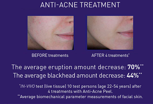 Anti Acne Treatment