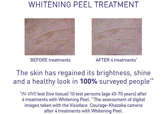 Whitening Treatmenty